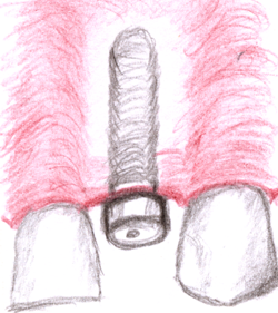 implantation (sketch)
