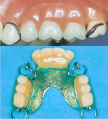 Cast-denture