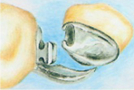 Attachment denture